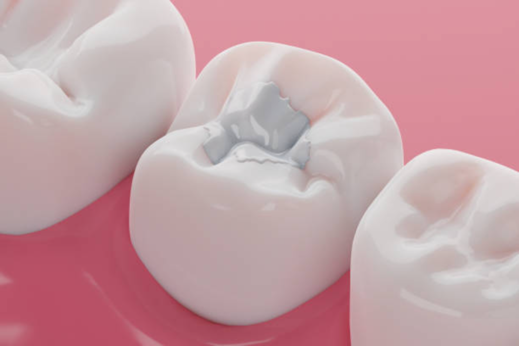 tooth-colored filling for cavities