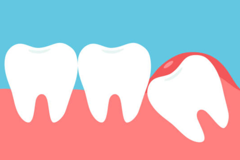 dental pain from impacted teeth