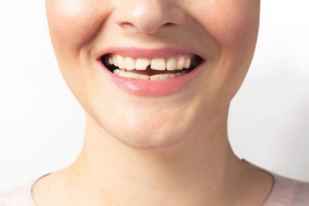 fixing smile gaps without braces