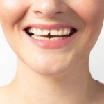 fixing smile gaps without braces