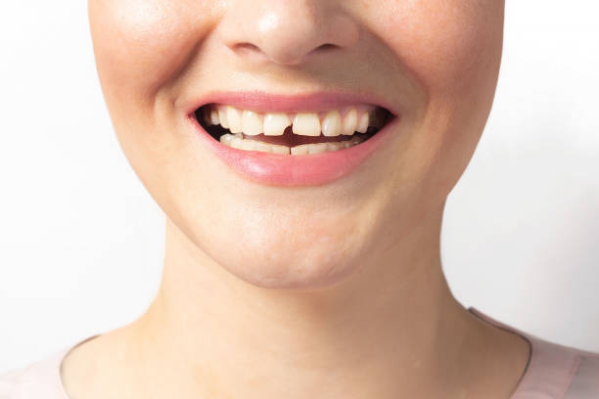 fixing smile gaps without braces