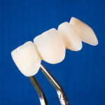signs a tooth needs a dental crown
