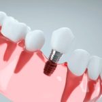 how dental implants prevent jawbone loss